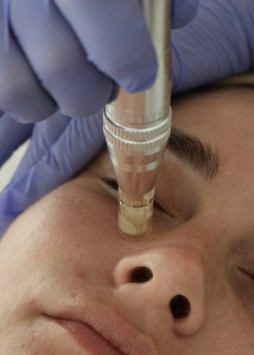 Tratamiento facial con Dermapen en La Réunion d’Amies, Málaga
